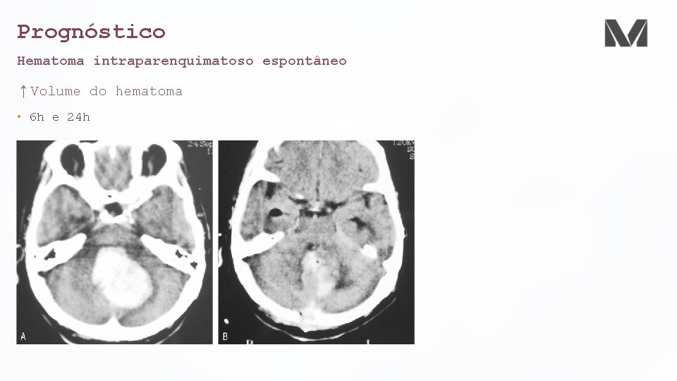 Prognóstico Hematoma intraparenquimatoso espontâneo ↑Volume do hematoma • 6 h e 24 h 