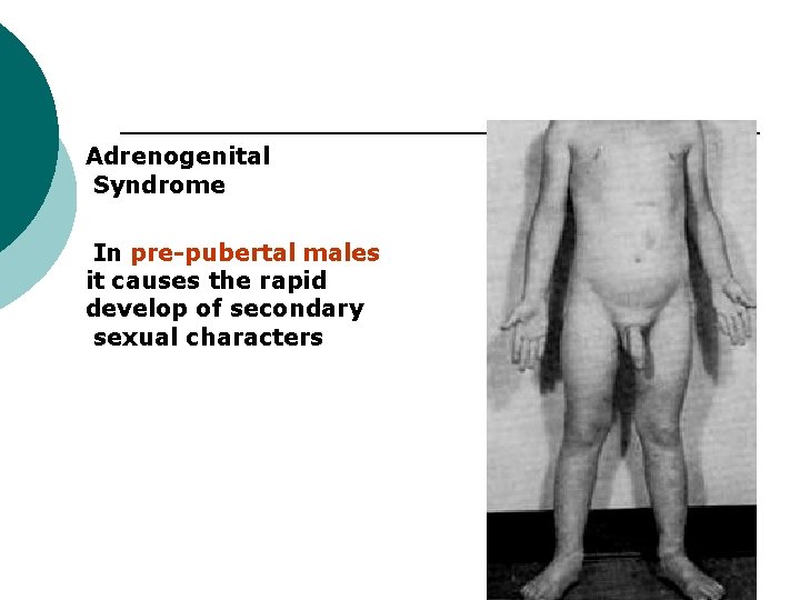 Adrenogenital Syndrome In pre-pubertal males it causes the rapid develop of secondary sexual characters