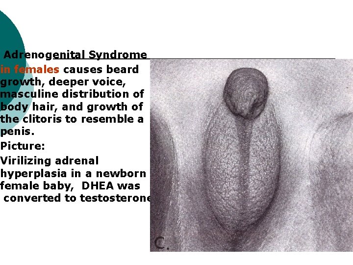 Adrenogenital Syndrome in females causes beard growth, deeper voice, masculine distribution of body hair,