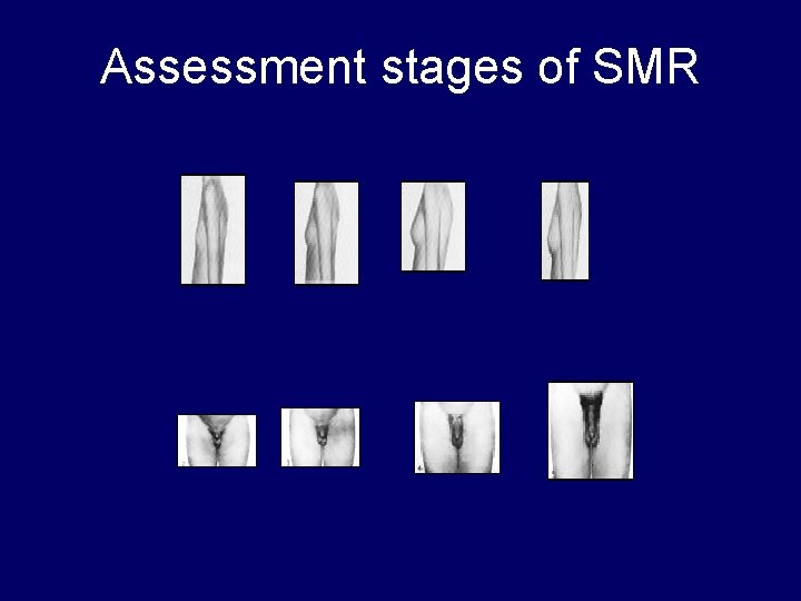 Assessment stages of SMR 