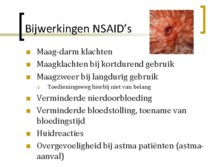 Bijwerkingen NSAID’s n n n Maag-darm klachten Maagklachten bij kortdurend gebruik Maagzweer bij langdurig