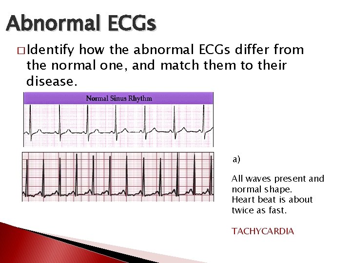 Abnormal ECGs � Identify how the abnormal ECGs differ from the normal one, and Abnormal ECGs � Identify how the abnormal ECGs differ from the normal one, and
