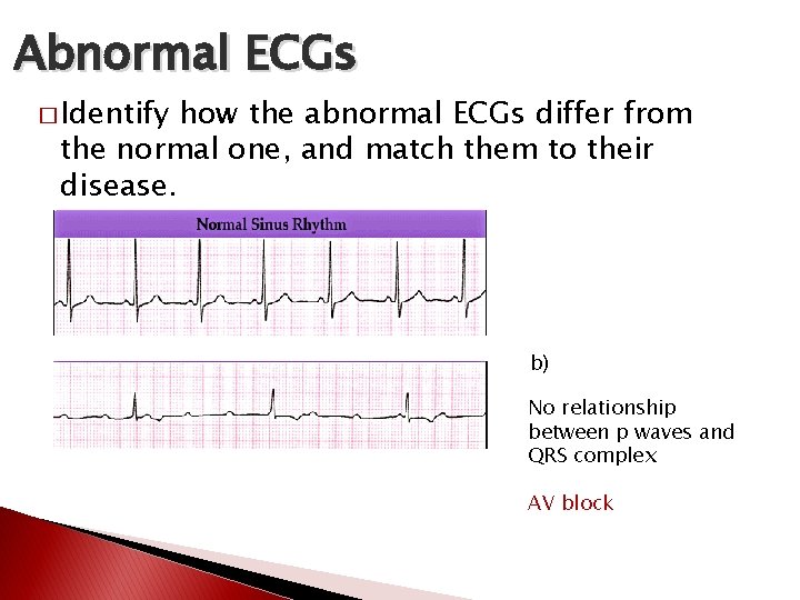 Abnormal ECGs � Identify how the abnormal ECGs differ from the normal one, and Abnormal ECGs � Identify how the abnormal ECGs differ from the normal one, and
