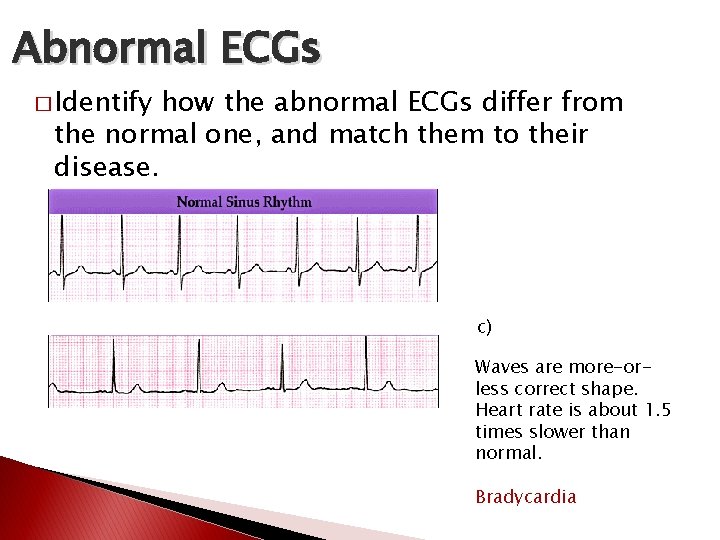 Abnormal ECGs � Identify how the abnormal ECGs differ from the normal one, and Abnormal ECGs � Identify how the abnormal ECGs differ from the normal one, and