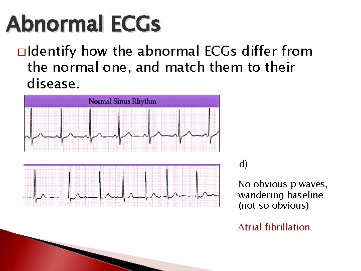 Abnormal ECGs � Identify how the abnormal ECGs differ from the normal one, and Abnormal ECGs � Identify how the abnormal ECGs differ from the normal one, and