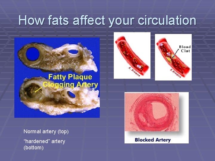 How fats affect your circulation Normal artery (top) “hardened” artery (bottom) 