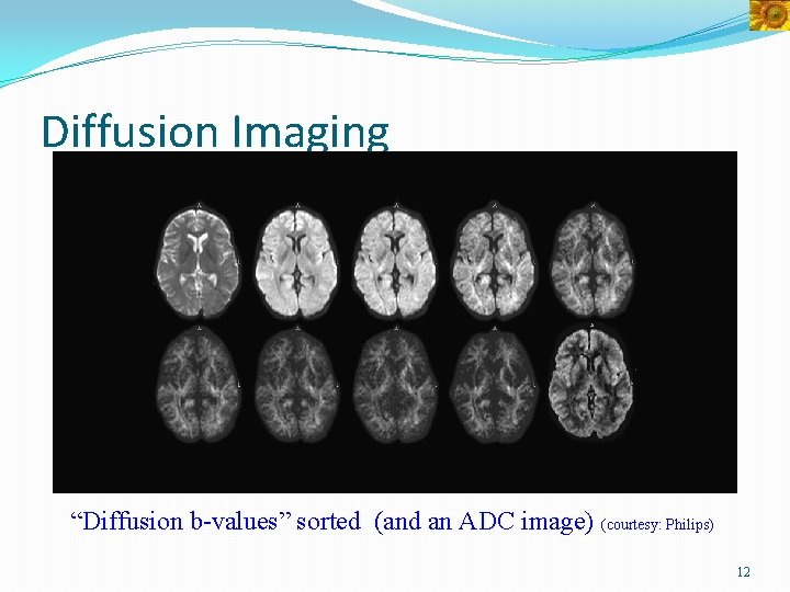 Diffusion Imaging “Diffusion b-values” sorted (and an ADC image) (courtesy: Philips) 12 