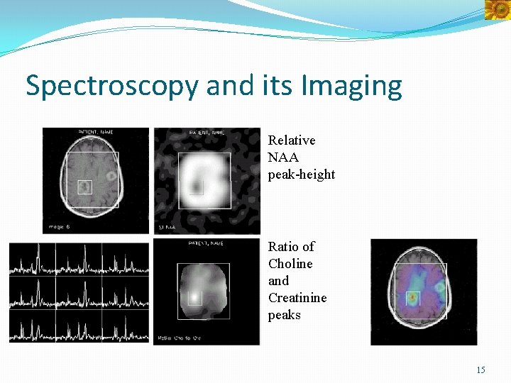 Spectroscopy and its Imaging Relative NAA peak-height Ratio of Choline and Creatinine peaks 15