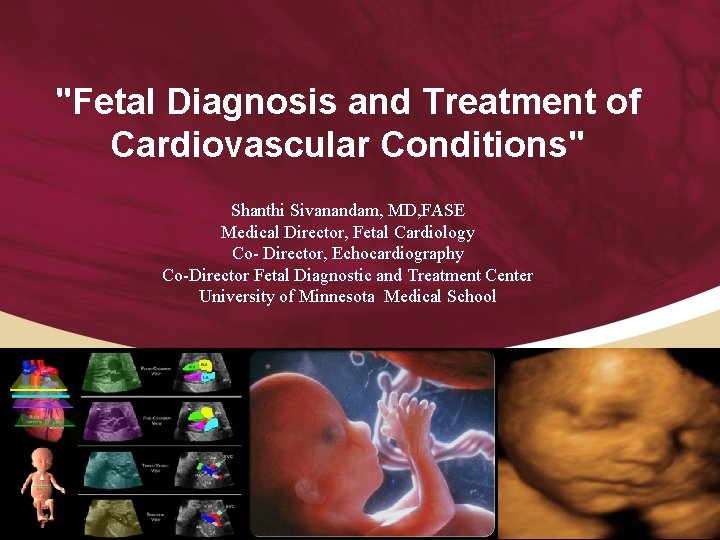 "Fetal Diagnosis and Treatment of Cardiovascular Conditions" Shanthi Sivanandam, MD, FASE Medical Director, Fetal