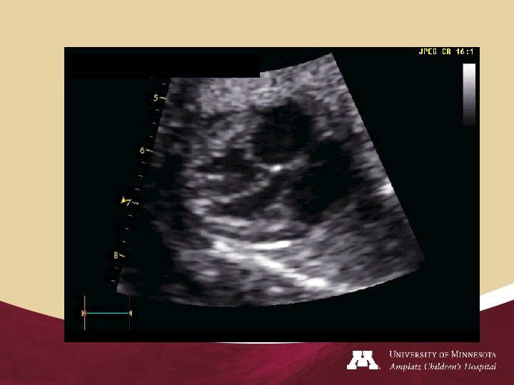 Fetal Echocardiography 