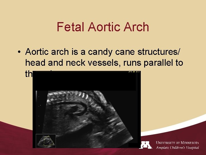 Fetal Aortic Arch • Aortic arch is a candy cane structures/ head and neck