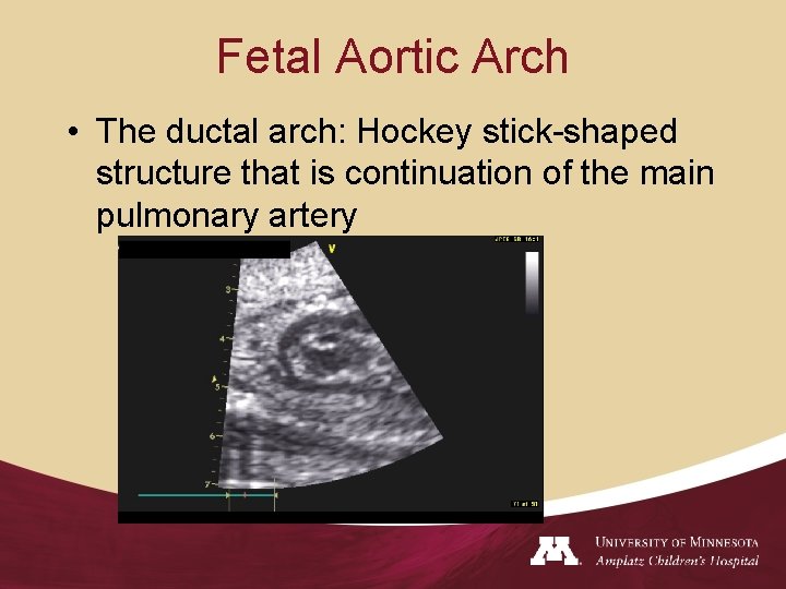 Fetal Aortic Arch • The ductal arch: Hockey stick-shaped structure that is continuation of