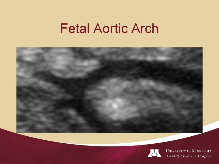 Fetal Aortic Arch 