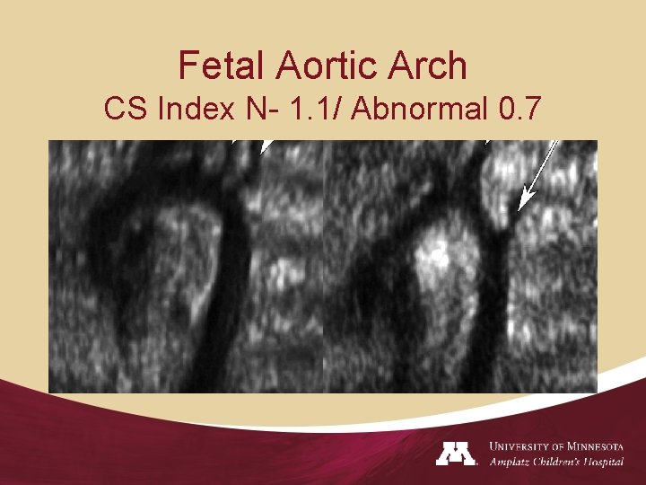 Fetal Aortic Arch CS Index N- 1. 1/ Abnormal 0. 7 