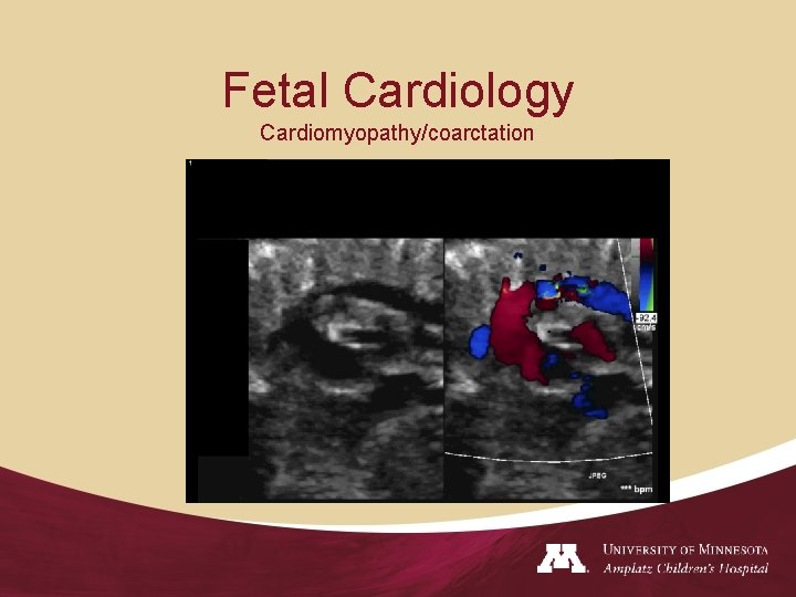 Fetal Cardiology Cardiomyopathy/coarctation 