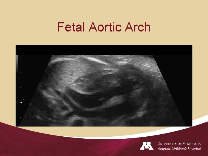 Fetal Aortic Arch 