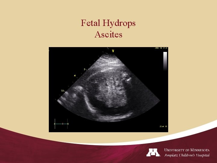 Fetal Hydrops Ascites 