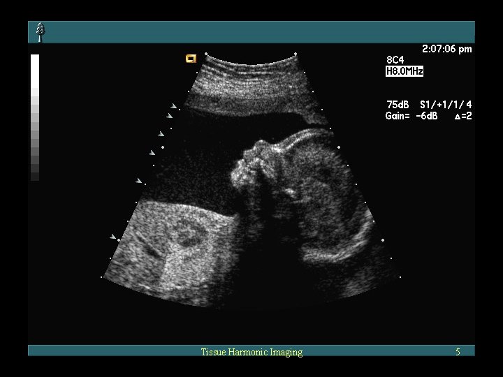 Tissue Harmonic Imaging 5 