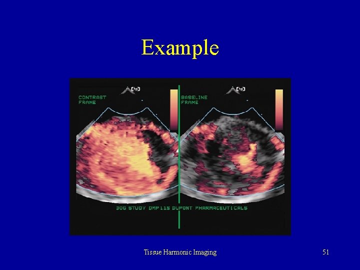 Example Tissue Harmonic Imaging 51 