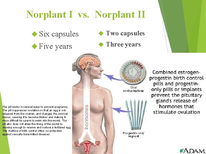 Norplant I vs. Norplant II Six capsules Five years The pill works in several