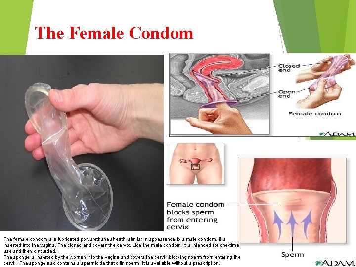The Female Condom The female condom is a lubricated polyurethane sheath, similar in appearance