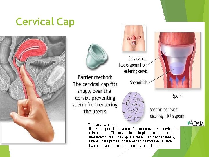 Cervical Cap The cervical cap is a flexible rubber cup-like device that is filled