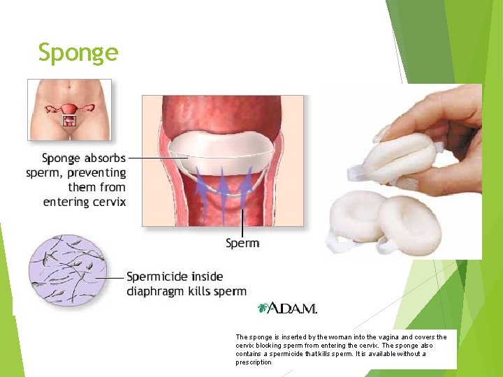 Sponge The sponge is inserted by the woman into the vagina and covers the