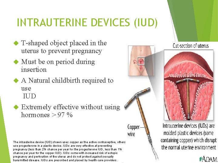 INTRAUTERINE DEVICES (IUD) T-shaped object placed in the uterus to prevent pregnancy Must be