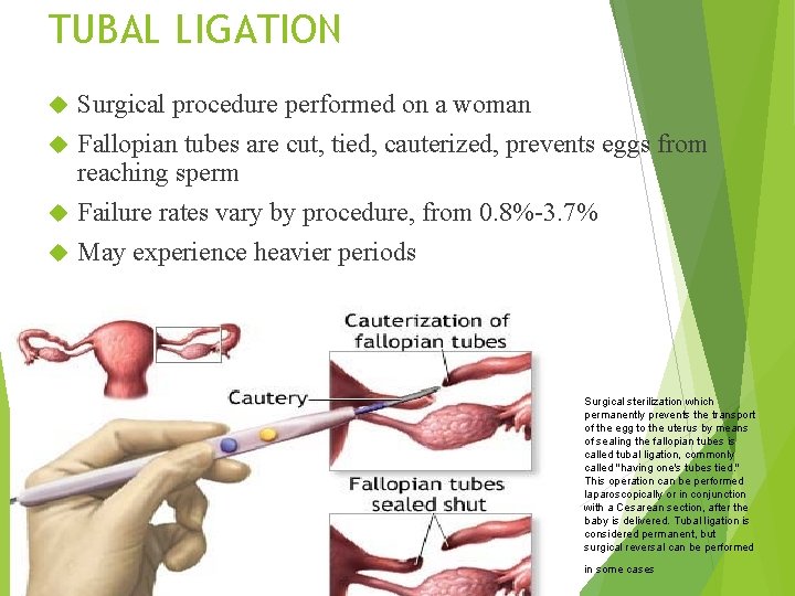 TUBAL LIGATION Surgical procedure performed on a woman Fallopian tubes are cut, tied, cauterized,