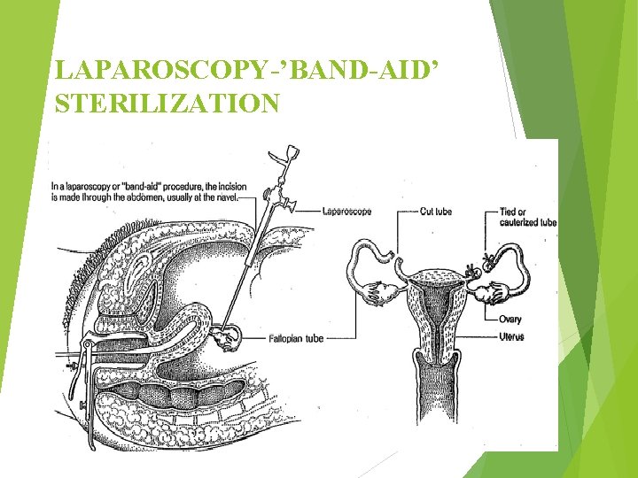 LAPAROSCOPY-’BAND-AID’ STERILIZATION 