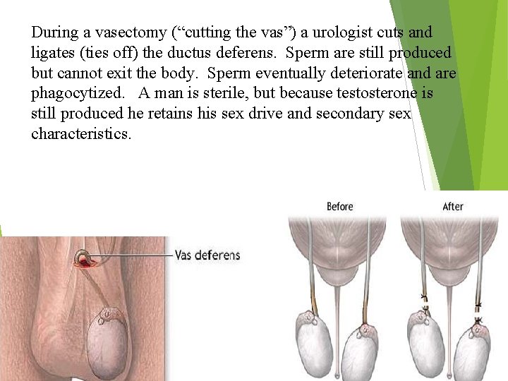 During a vasectomy (“cutting the vas”) a urologist cuts and ligates (ties off) the