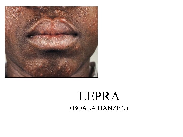 LEPRA (BOALA HANZEN) 