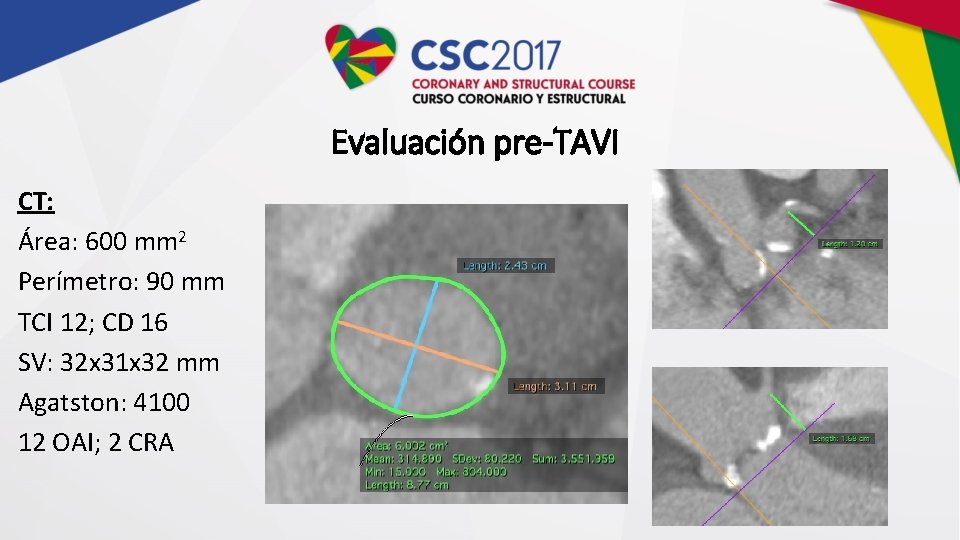 Evaluación pre-TAVI CT: Área: 600 mm 2 Perímetro: 90 mm TCI 12; CD 16