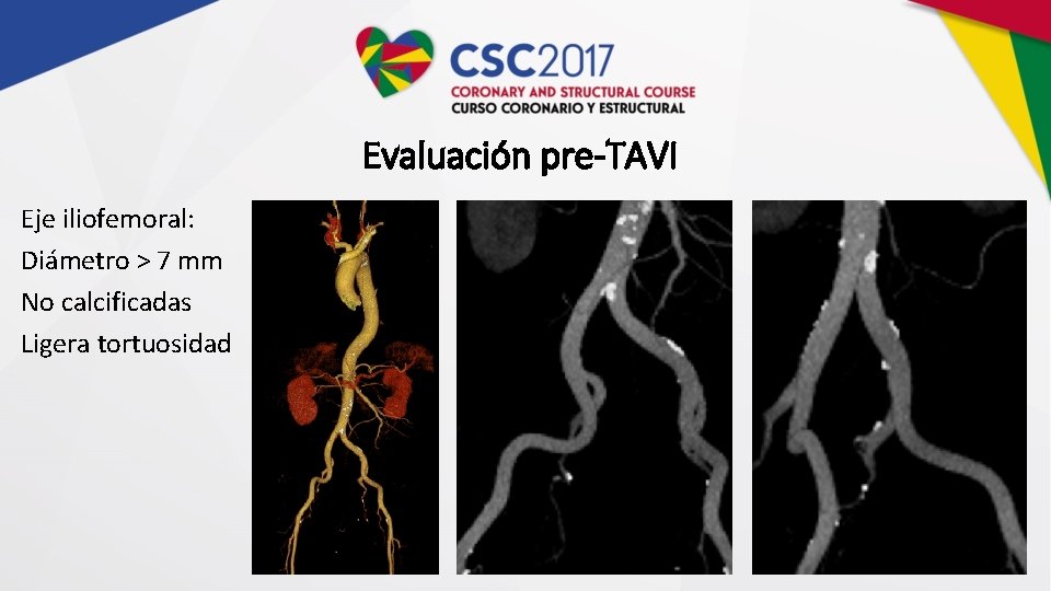 Evaluación pre-TAVI Eje iliofemoral: Diámetro > 7 mm No calcificadas Ligera tortuosidad 