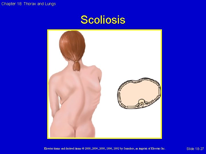 Chapter 18: Thorax and Lungs Scoliosis Elsevier items and derived items © 2008, 2004,