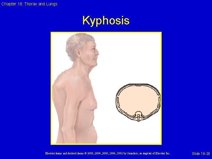 Chapter 18: Thorax and Lungs Kyphosis Elsevier items and derived items © 2008, 2004,