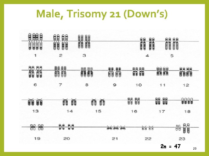 Male, Trisomy 21 (Down’s) 2 n = 47 20 