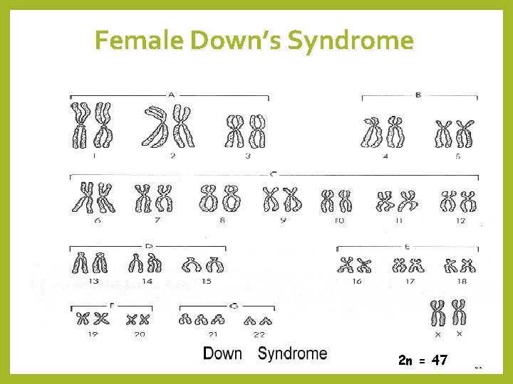 Female Down’s Syndrome 2 n = 47 21 