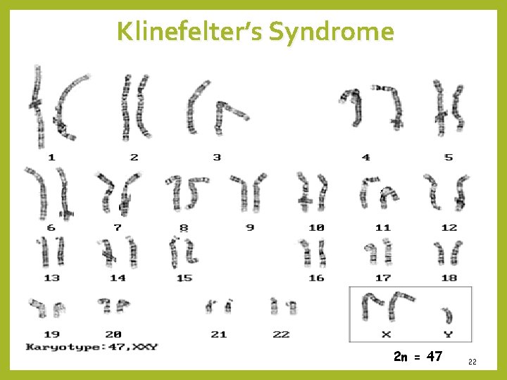 Klinefelter’s Syndrome 2 n = 47 22 