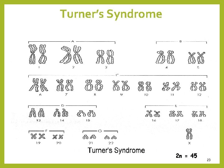 Turner’s Syndrome 2 n = 45 23 