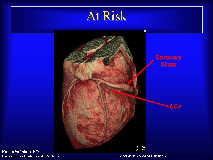 At Risk Coronary Sinus LCx Maurice Buchbinder, MD Foundation for Cardiovascular Medicine Courtesy of