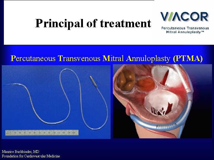 Principal of treatment Percutaneous Transvenous Mitral Annuloplasty (PTMA) Maurice Buchbinder, MD Foundation for Cardiovascular