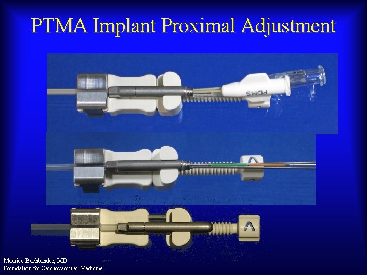 PTMA Implant Proximal Adjustment Maurice Buchbinder, MD Foundation for Cardiovascular Medicine 