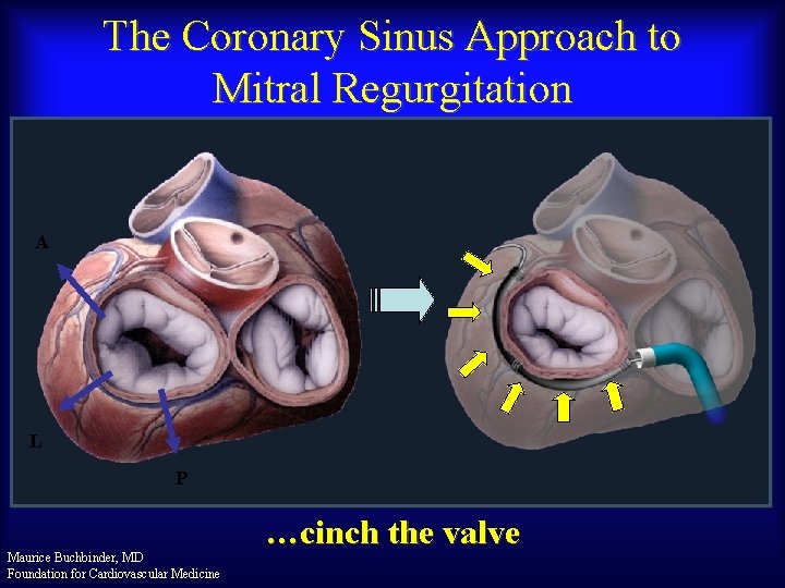 The Coronary Sinus Approach to Mitral Regurgitation A L P Maurice Buchbinder, MD Foundation