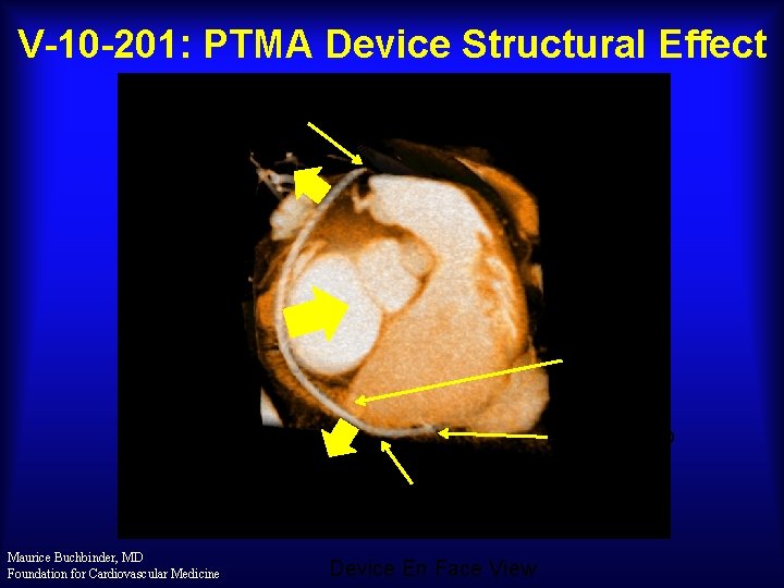 V-10 -201: PTMA Device Structural Effect Distal Nitinol Extremity CSO Proximal R/O Marker Treatment