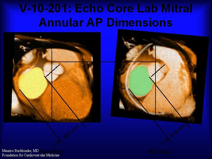 V-10 -201: Echo Core Lab Mitral Annular AP Dimensions m m . 5 8