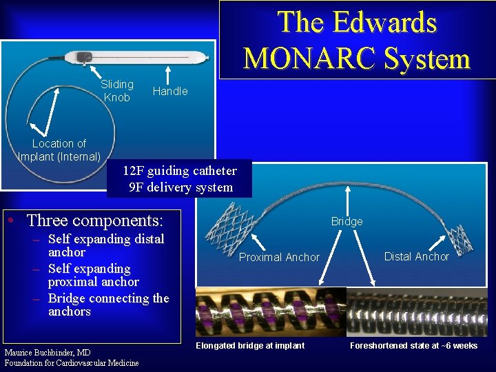 The Edwards MONARC System Sliding Knob Location of Implant (Internal) Handle 12 F guiding