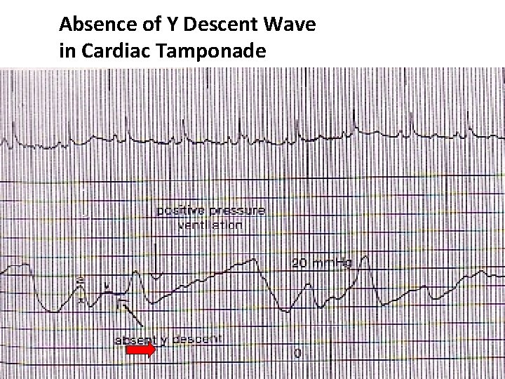 Absence of Y Descent Wave in Cardiac Tamponade 