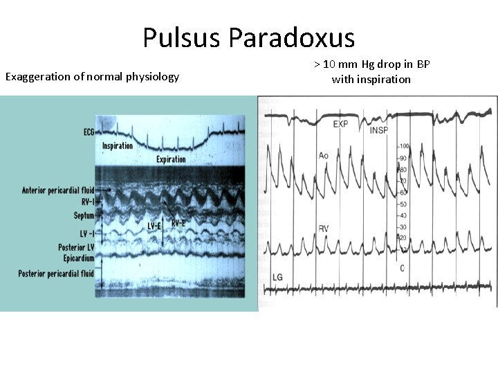 Pulsus Paradoxus Exaggeration of normal physiology > 10 mm Hg drop in BP with