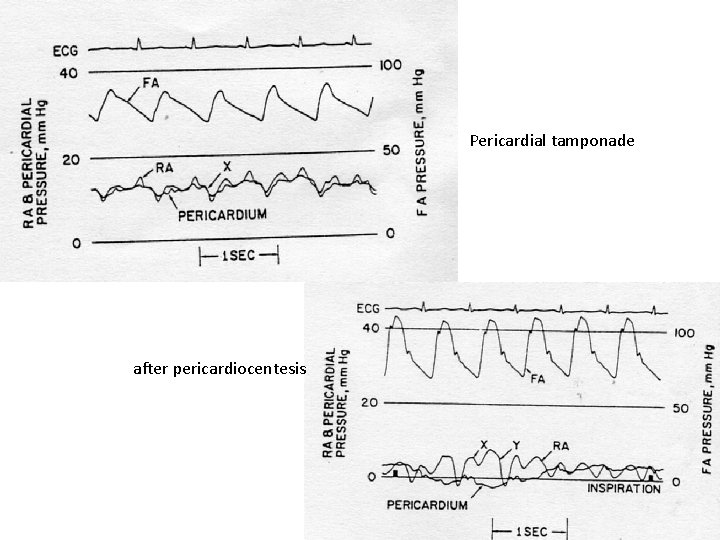 Pericardial tamponade after pericardiocentesis 